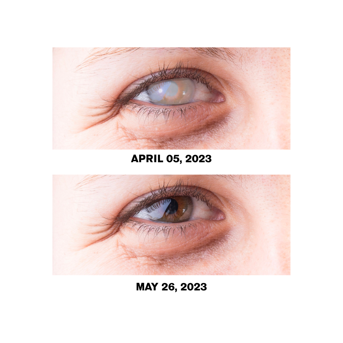 Ourlyard™ Treatment EyeProblems SolutionDrops